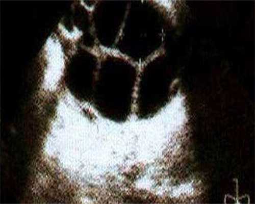 浙江有严重弱精可以三代代生求电话生孩子吗(男方弱精症可以做代生求电话吗